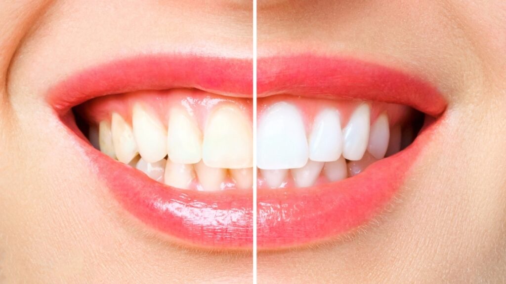 Understanding the Color of Our Teeth