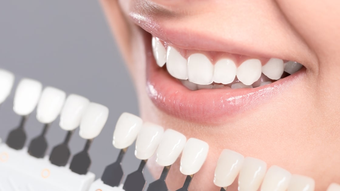 Is having white teeth healthy? Teeth check up.